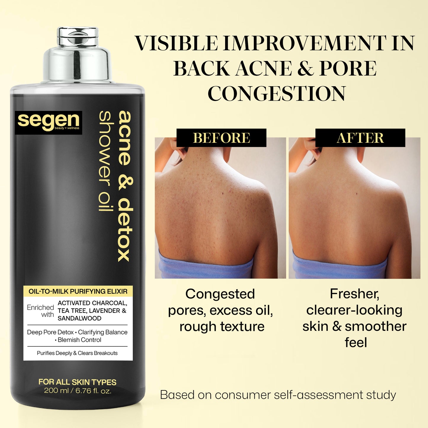 Segen Acne & Detox Shower Oil – Oil-to-Milk Purifying Cleanser with Activated Charcoal, Tea Tree & Sandalwood | Deep Pore Detox & Blemish Control - 200 ml
