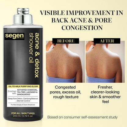 Segen Acne & Detox Shower Oil – Oil-to-Milk Purifying Cleanser with Activated Charcoal, Tea Tree & Sandalwood | Deep Pore Detox & Blemish Control - 200 ml