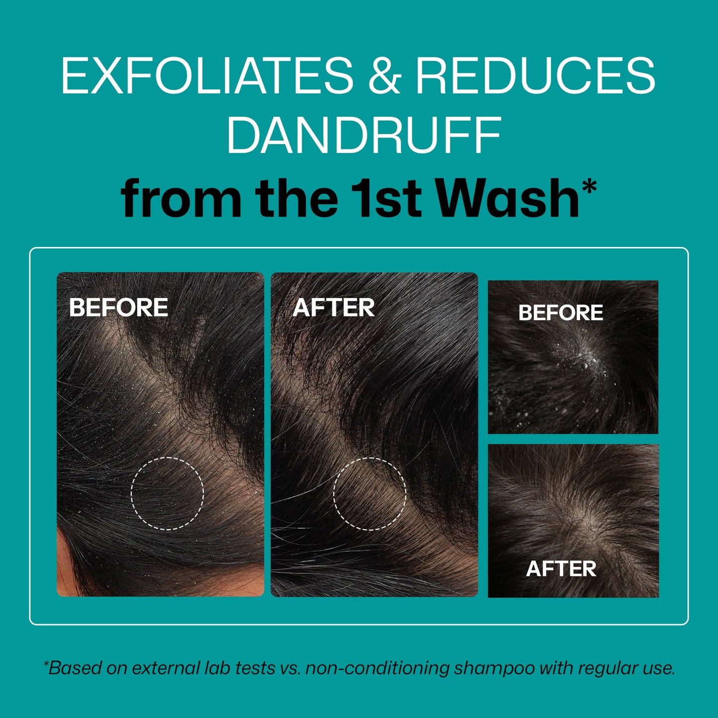 Segen Anti-Dandruff Shampoo with Salicylic Acid, Biotin & Tea Tree | 100% Dandruff Reduction