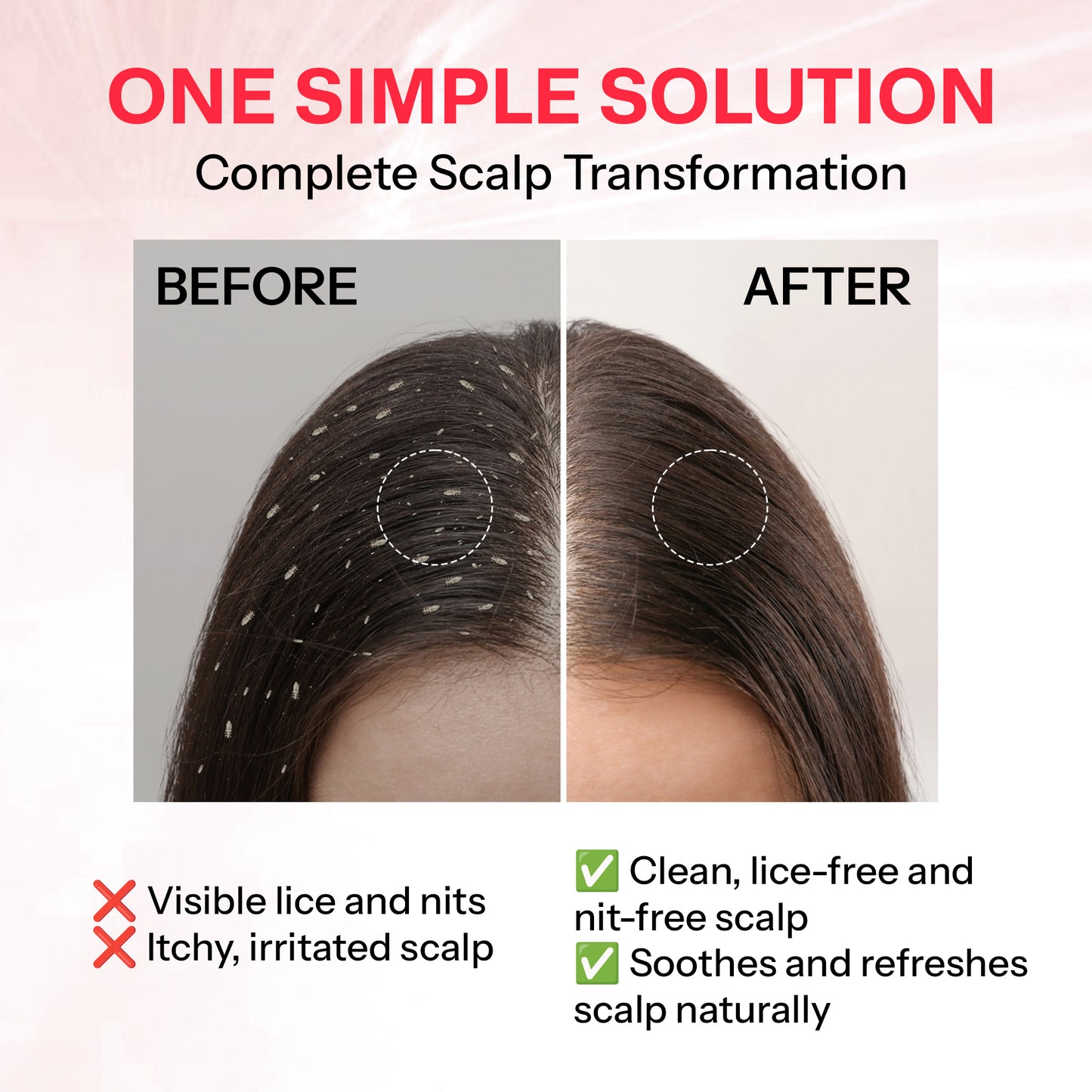 Segen NITSOL 100% Natural Head Lice Solution | Kills Lice & Eggs in One Go | Gentle on Scalp & Hair - 100ml